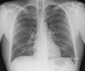 Ai fost infectat cu SarsCov2 și ți-a fost afectată capacitatea respiratorie? Învață să respiri (din nou) cum respirai înainte de… Covid-19: program online GRATUIT